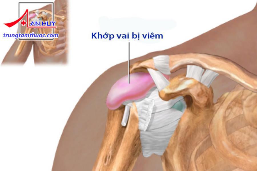 Viêm quanh khớp vai được điều trị như thế nào?