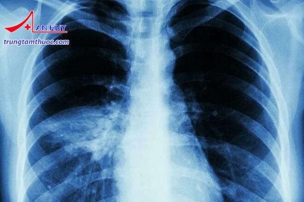 Hướng dẫn chẩn đoán và điều trị viêm phổi không đáp ứng ...
