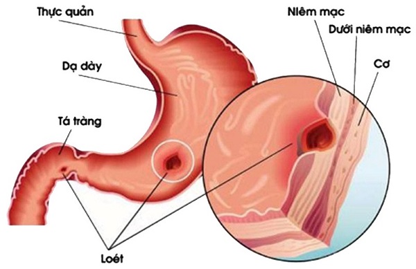 viêm loét dạ dày - tá tràng