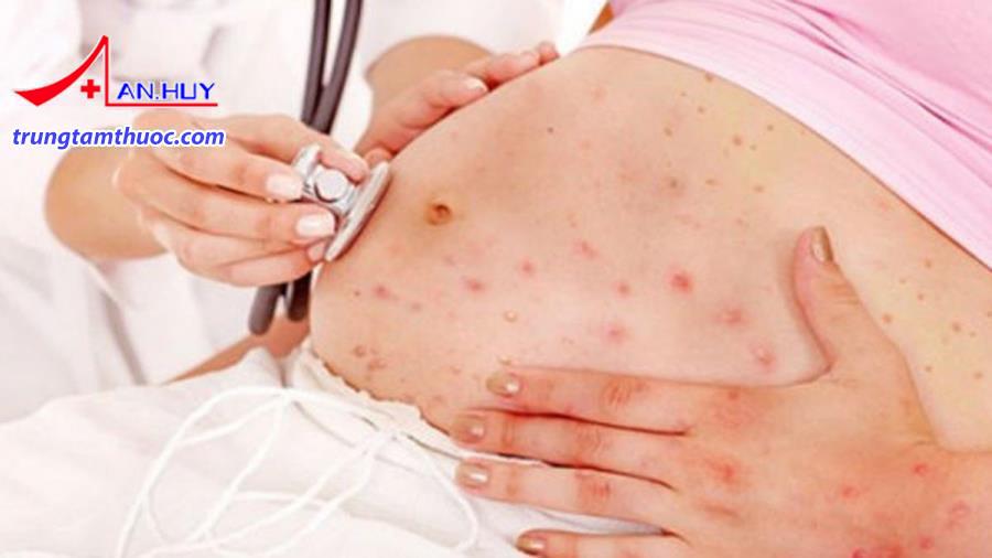 PNMT dễ bị mụn
