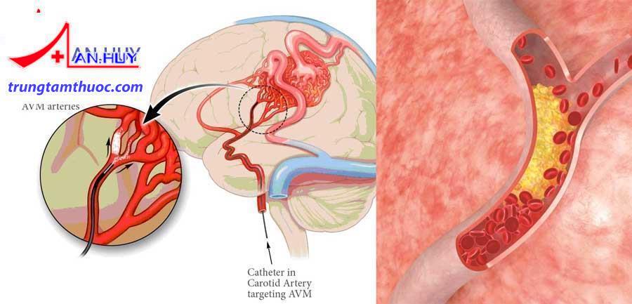 mạch máu nhỏ gây tai biến mạch máu não