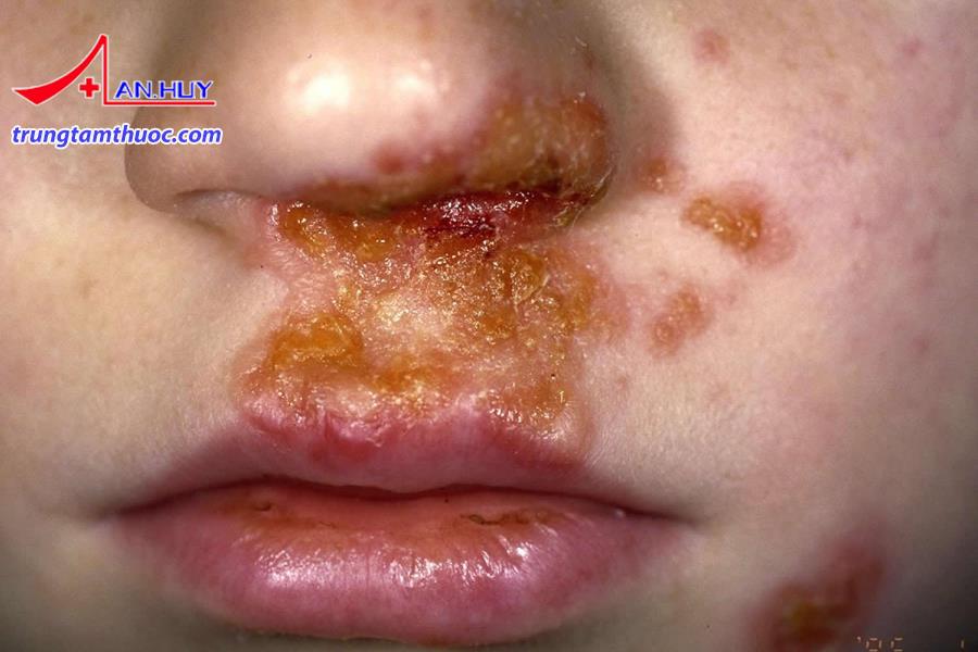 BỆNH CHỐC LỞ PHƯƠNG PHÁP ĐIỀU TRỊ VÀ PHÒNG NGỪA HIỆU QUẢ