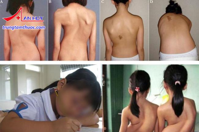 Trẻ mắc bệnh lý về cột sống có những biểu hiện như thế nào?