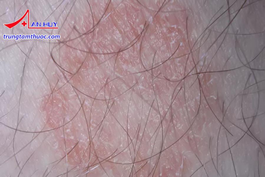Nấm sợi gây ra các bệnh biểu hiện trên da.