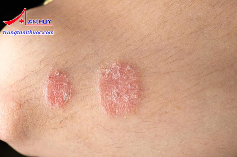 Nấm sợi gây ra các biểu hiện trên bộ phân nào?