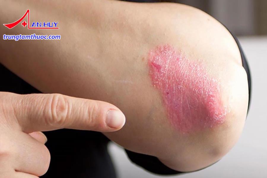 Điều trị bệnh da do nấm sợi như thế nào?