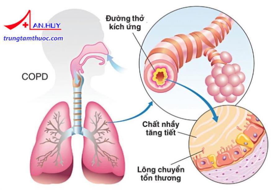 Minh họa đường thở trong bệnh phổi tắc nghẽn mạn tính