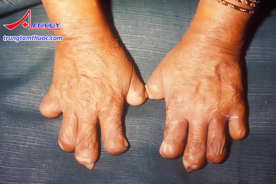 Bệnh phong được điều trị như thế nào?