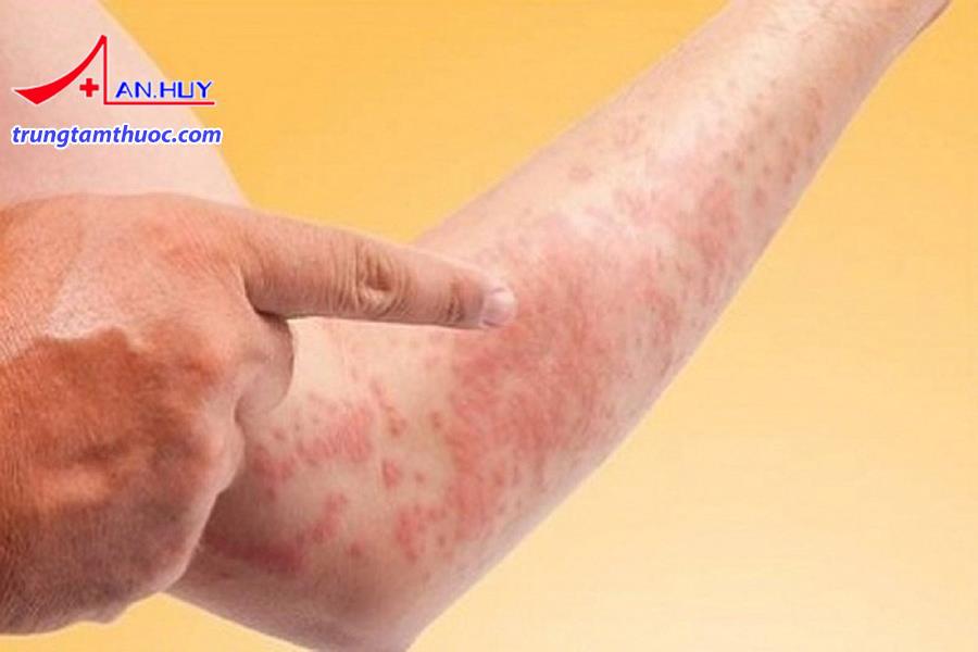 Bệnh phong được chẩn đoán căn cứ vào các triệu chứng lâm sàng.