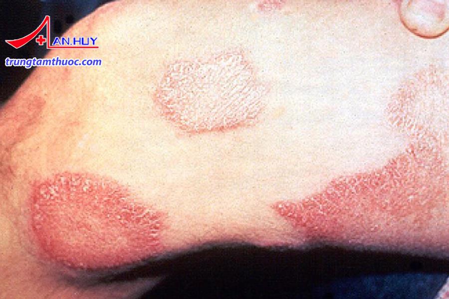 Bệnh phong là do loài vi khuẩn Mycobacterium leprae gây ra.