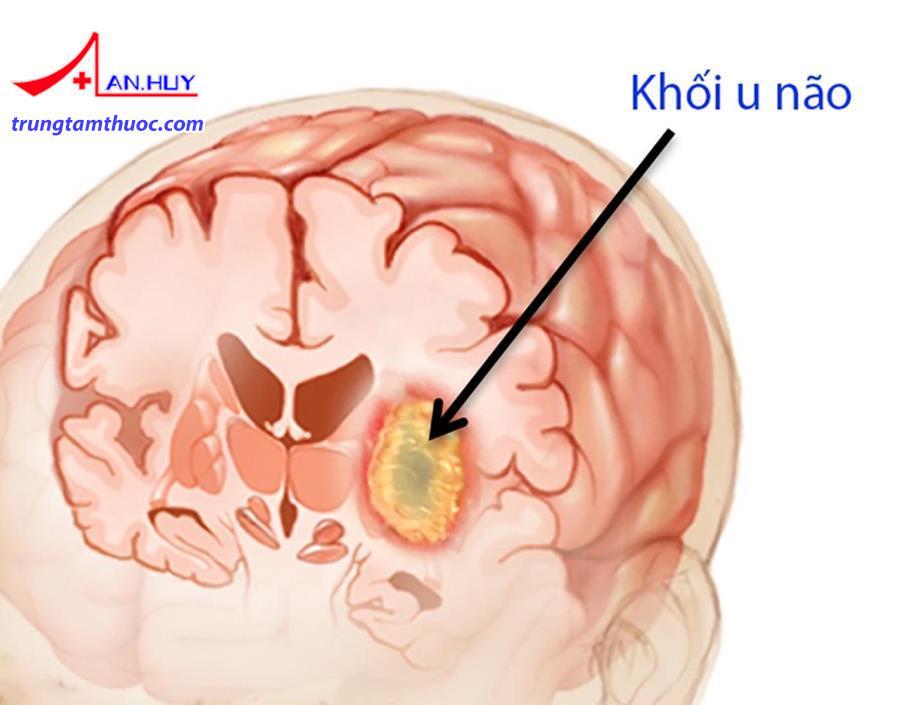 U não cũng có thể gây não úng thủy.