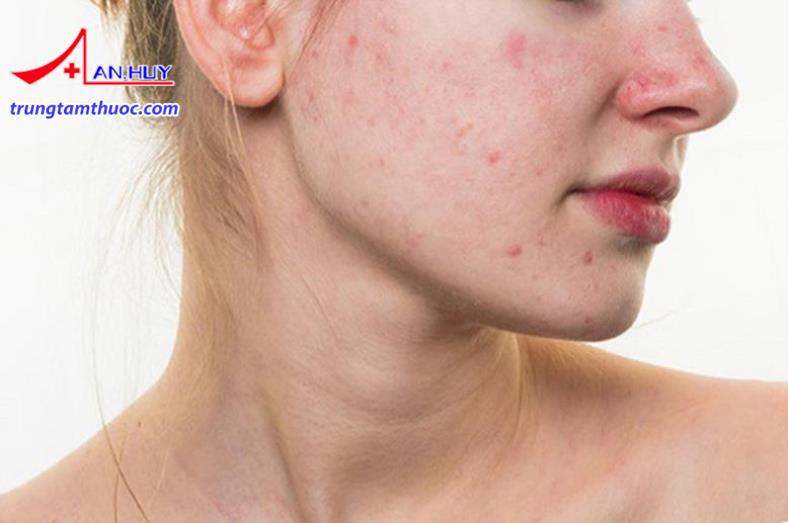 Da tiết nhiền bã nhờn và nổi nhiều mụn có thể là do mất cân bằng nội tiết