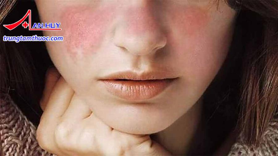 Triệu chứng bệnh tan máu tự miễn
