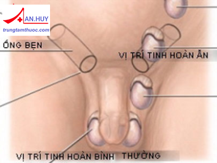 Suy sinh dục nam