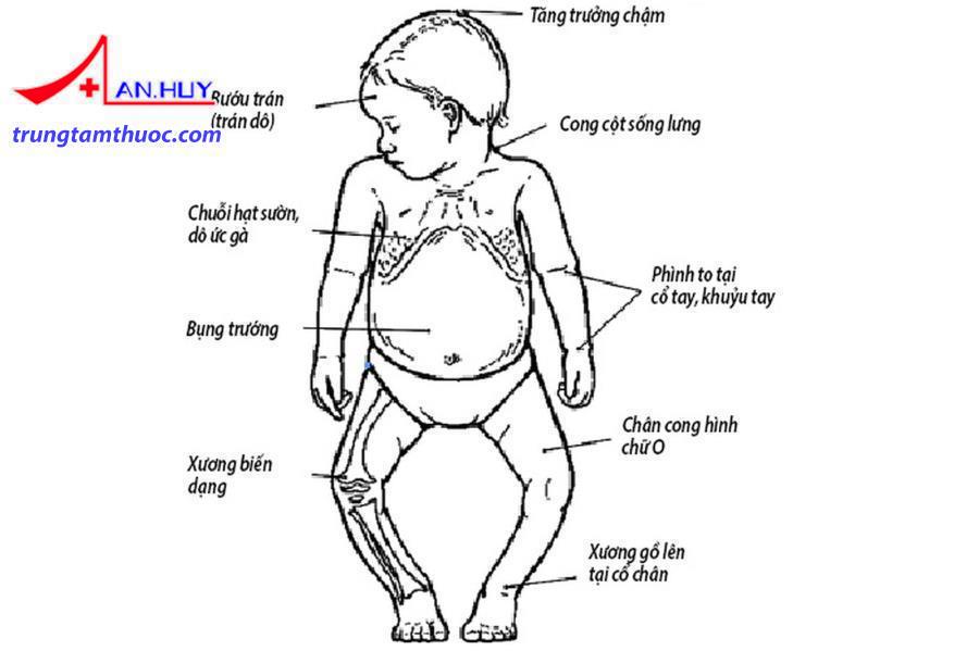 Trẻ bị còi xương có biểu hiện trên các cơ quan của cơ thể.