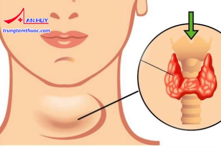 Điều trị nội khoa cho bệnh nhân cường giáp