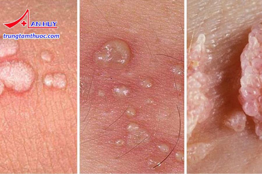 Bệnh lây truyền qua đường tình dục có những dấu hiệu gì?