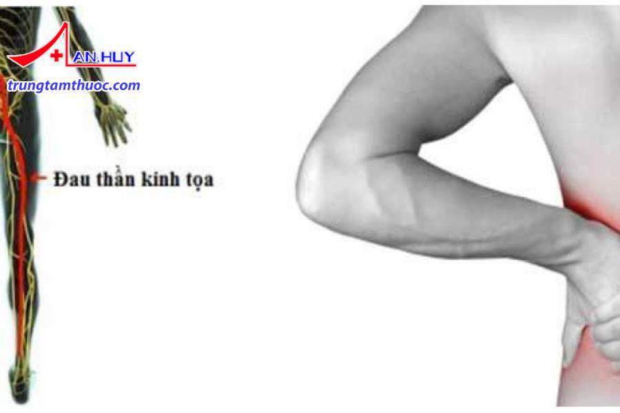 Chẩn đoán đau thần kinh tọa như thế nào?