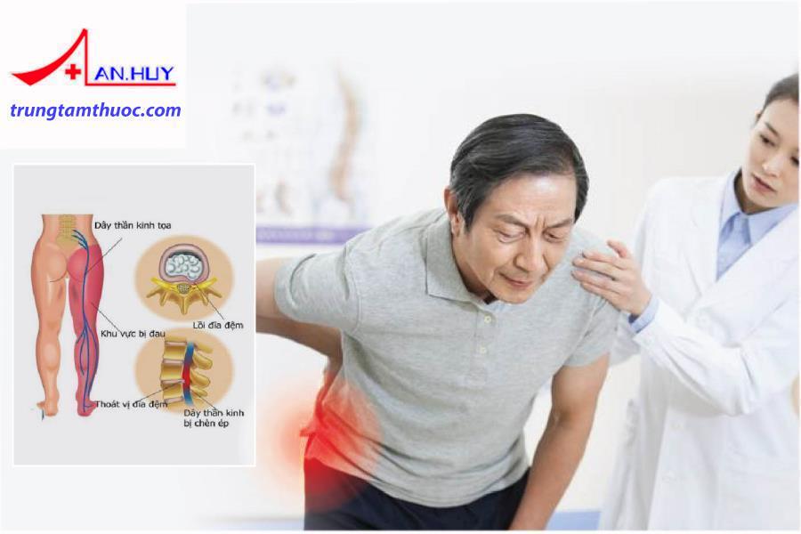 Đau thần kinh tọa khiến người bệnh thường xuyên đau nhức