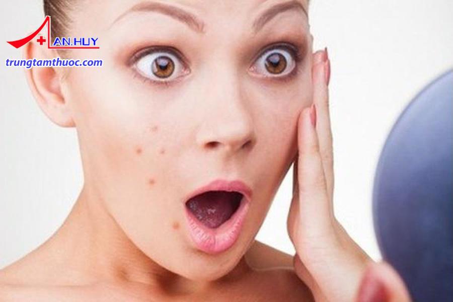 Dị ứng mỹ phẩm làm nổi mụn trên da mặt.