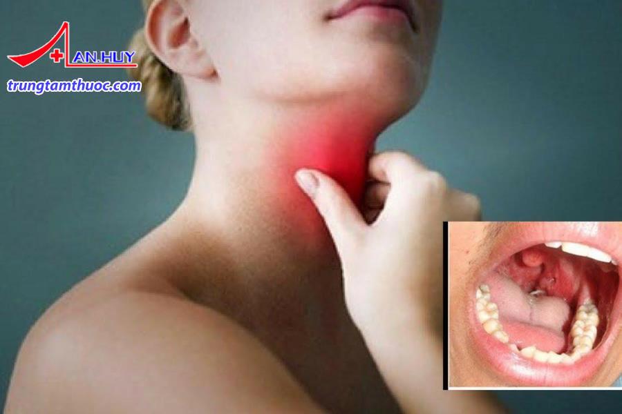 Dị vật thực quản là do thói quen ăn uống hay có khối u.