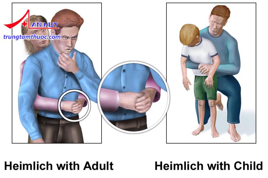 Dị vật đường thở cấp cứu bằng phương pháp Heimlich.
