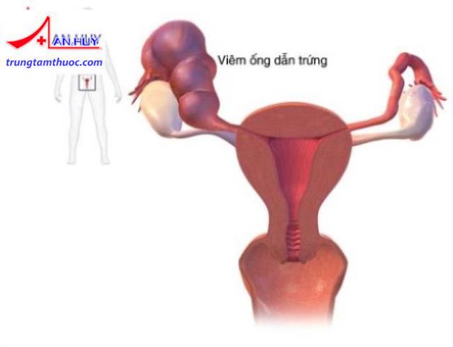 Áp xe phần phụ