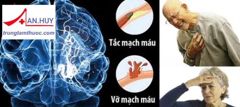 Đột quỵ là gì