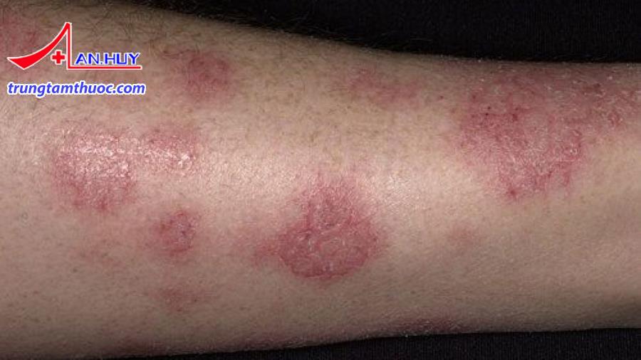 Eczema gây ngứa kéo dài.