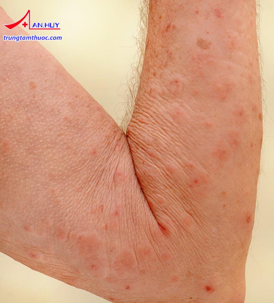 Người bệnh bị nhiễm con ghẻ, có các mụn nước ẩn dưới da.