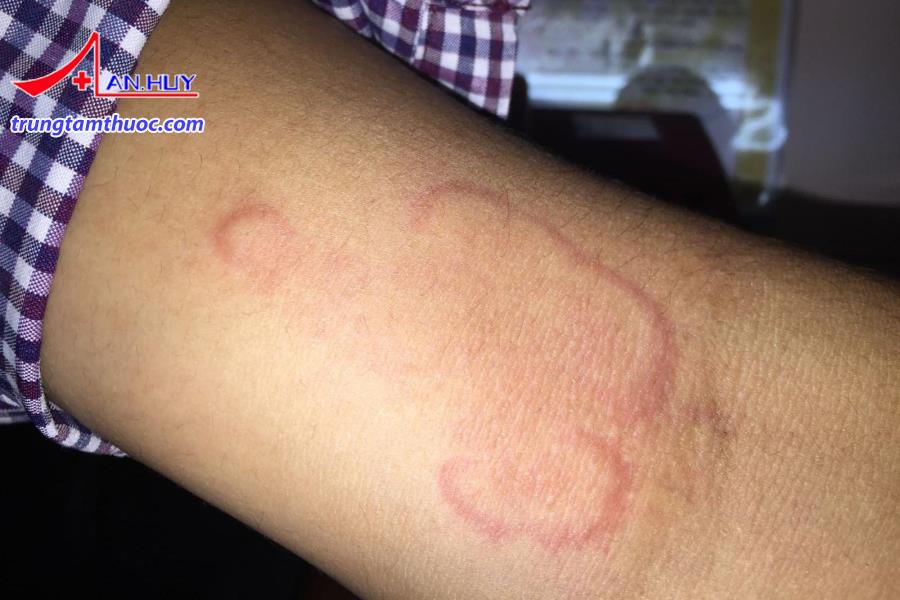 Điều trị giun chỉ bạch huyết như thế nào