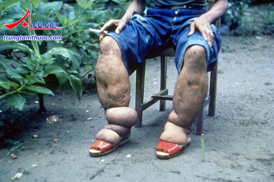Giun chỉ bạch huyết có triệu chứng như thế nào?