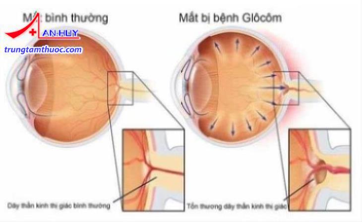 Bệnh glocom là gì?