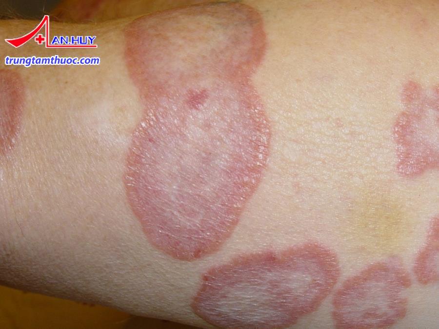 Người bệnh hắc lào thường thấy xuất hiện các đốm tròn, bầu dục.