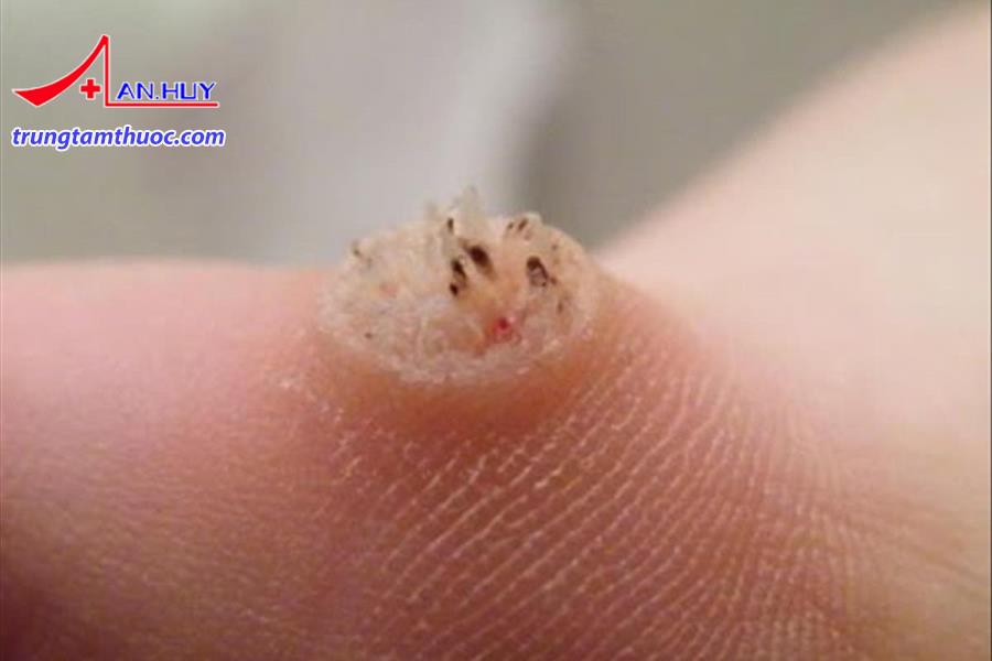 Điều trị bệnh hạt cơm như thế nào?