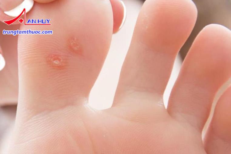 Bệnh hạt cơm là sự tăng sinh lành tính của da