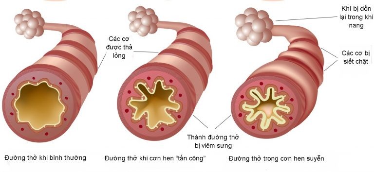 So sánh đường thở bình thường, trong cơn hen, và sau cơn hen