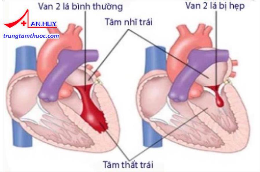 Hẹp van hai lá là bệnh tương đối phổ biến ở nước ta.