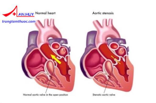 Hẹp van hai lá được điều trị như thế nào?