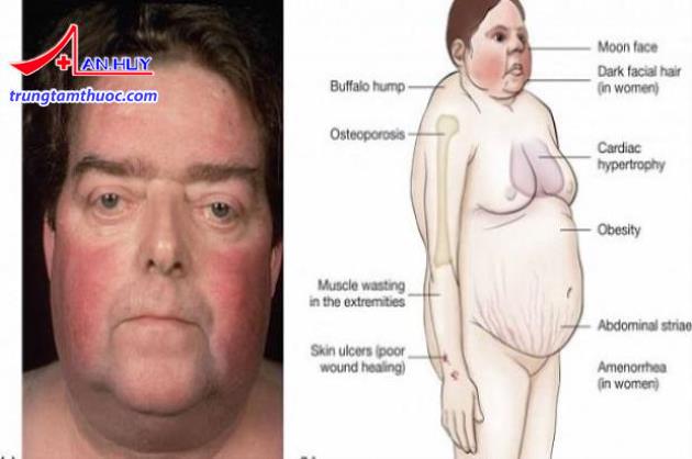 Các triệu chứng Cushing do dùng corticoid.