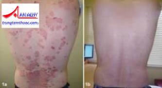 Điều trị vảy nến