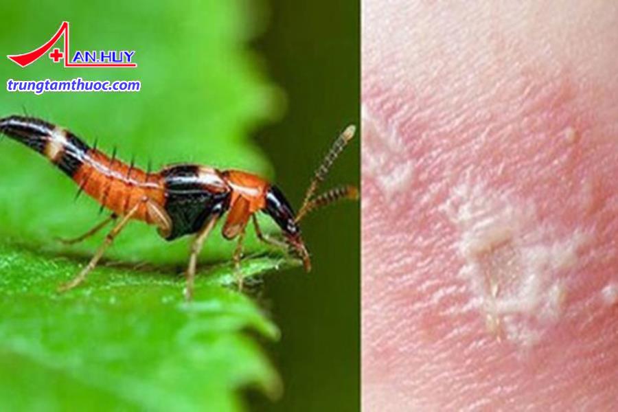Tiếp xúc với độc tố của kiến ba khoang gây triệu chứng trên da.