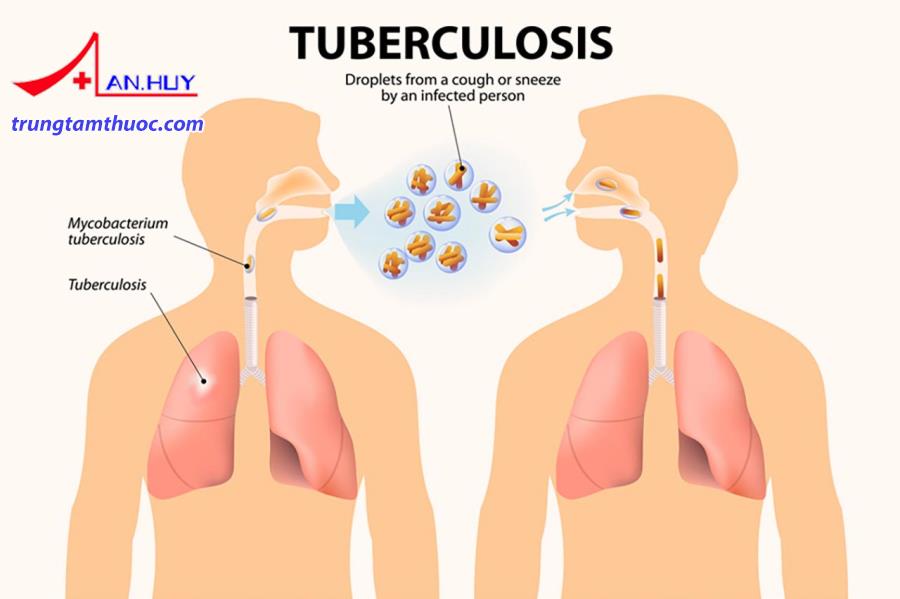 Lao phổi là bệnh truyền nhiễm lây từ người sang người qua giọt bắn không khí.