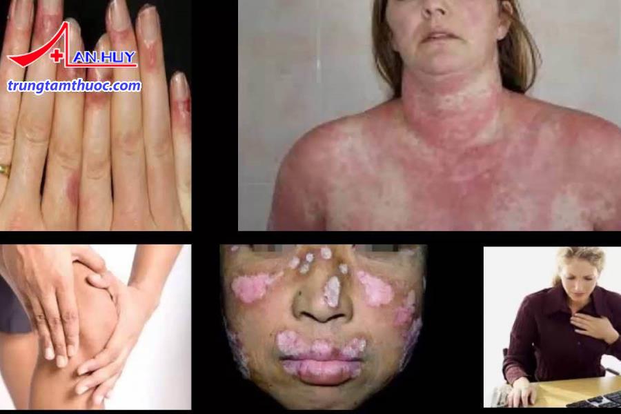 Lupus ban đỏ hệ thống là bệnh tự miễn, ảnh hưởng đến đa cơ quan.