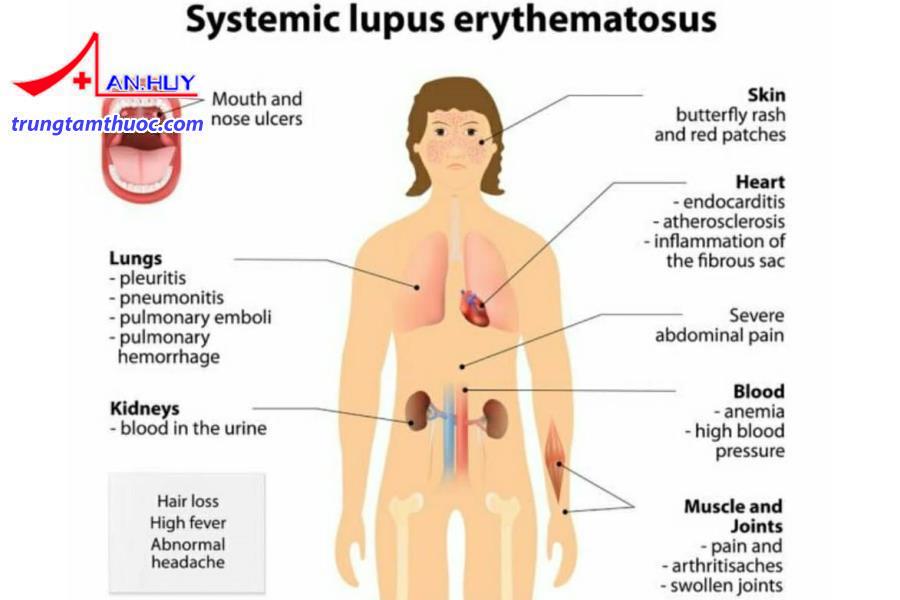 Điều trị lupus ban đỏ hệ thống cần đánh giá mức độ nặng, nhẹ của người bệnh.