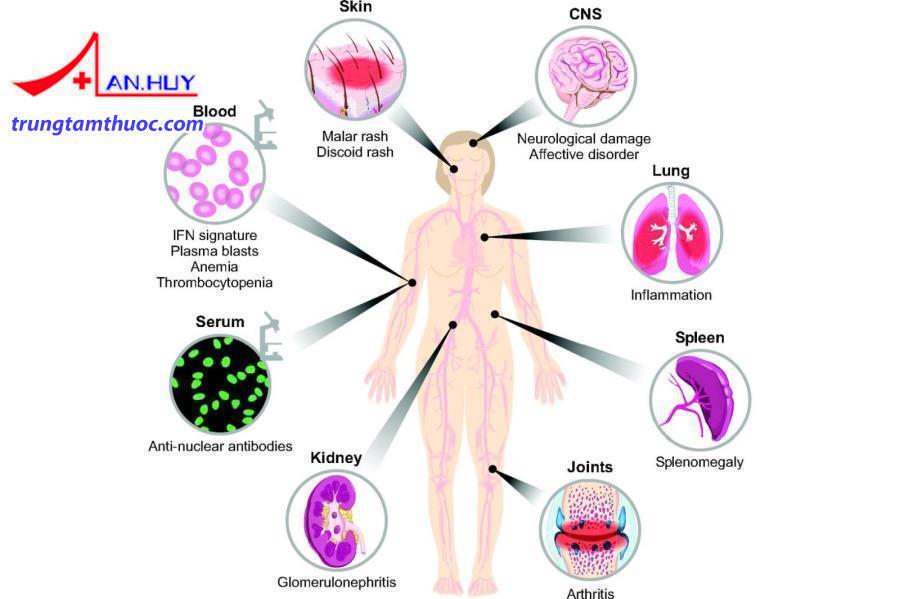 Lupus ban đỏ hệ thống gây ra những triệu chứng gì?
