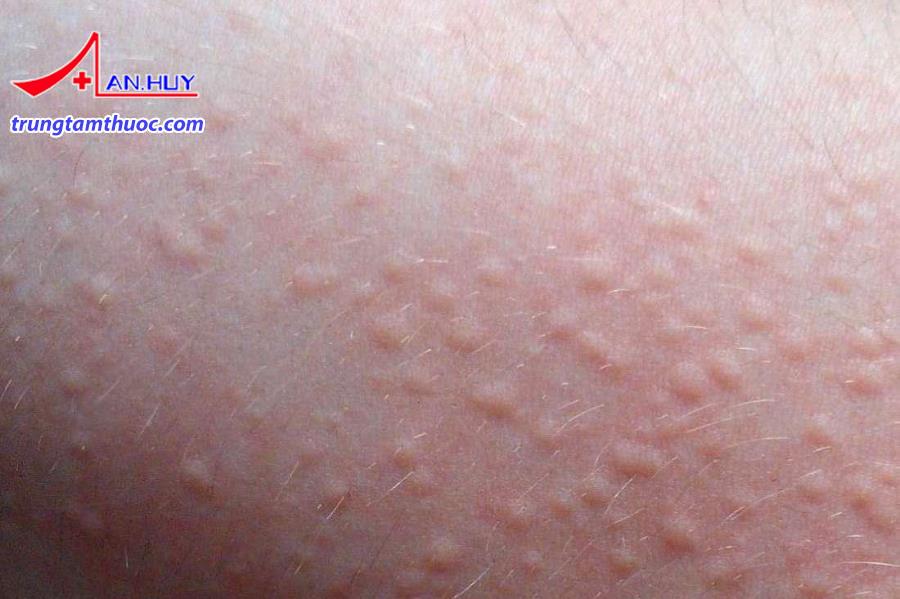 Bệnh mày đay là gì?