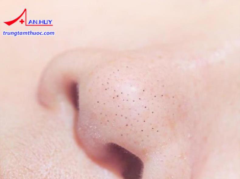 Sự xuất hiện của mụn đầu đen