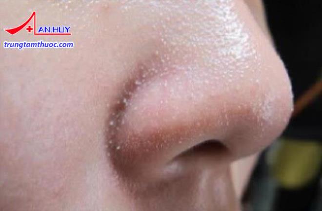 Hình ảnh mụn đầu trắng