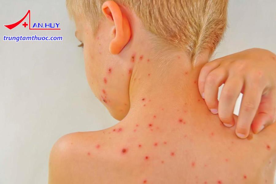 Nhiễm khuẩn huyết có các triệu chứng như thế nào?